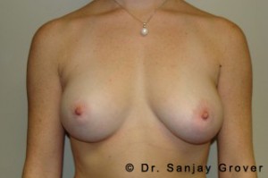Breast Augmentation Before and After 12 | Sanjay Grover MD FACS