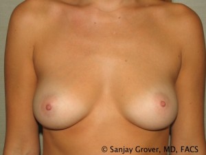 Breast Augmentation Before and After 190 | Sanjay Grover MD FACS