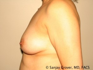 Breast Augmentation Before and After 69 | Sanjay Grover MD FACS