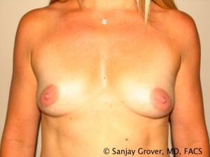 Breast Augmentation Before and After 163 | Sanjay Grover MD FACS