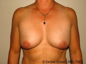 Breast Augmentation Before and After 245 | Sanjay Grover MD FACS