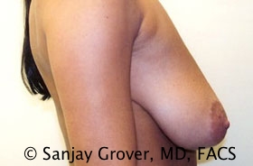 Breast Lift Before and After 23 | Sanjay Grover MD FACS