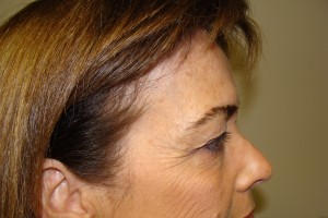 Browlift Before and After 15 | Sanjay Grover MD FACS