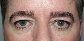 Blepharoplasty Before and After 09 | Sanjay Grover MD FACS