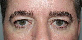 Blepharoplasty Before and After 18 | Sanjay Grover MD FACS