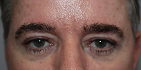 Blepharoplasty Before and After | Grover Aesthetics