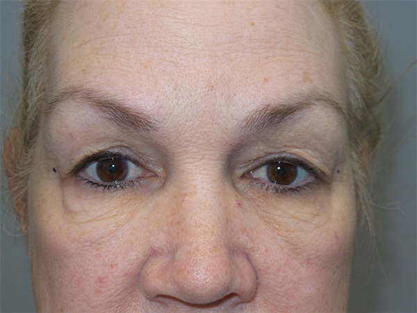 Blepharoplasty Before and After 27 | Sanjay Grover MD FACS