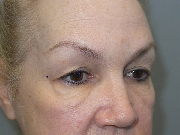 Blepharoplasty Before and After 02 | Sanjay Grover MD FACS