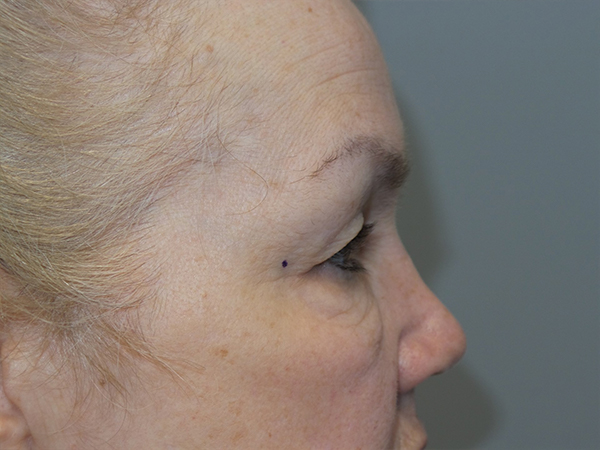 Blepharoplasty Before and After 02 | Grover Aesthetics
