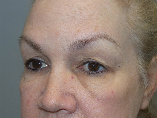 Blepharoplasty Before and After 02 | Sanjay Grover MD FACS