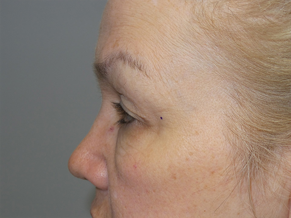 Blepharoplasty Before and After 02 | Grover Aesthetics
