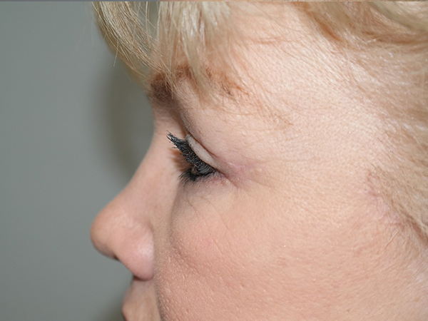 Blepharoplasty Before and After 02 | Grover Aesthetics