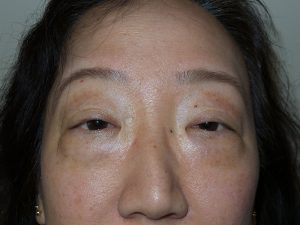 Blepharoplasty Before and After | Grover Aesthetics