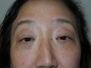 Blepharoplasty Before and After 03 | Sanjay Grover MD FACS
