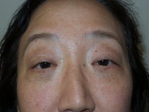 Blepharoplasty Before and After | Sanjay Grover MD FACS