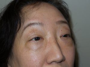 Blepharoplasty Before and After 03 | Sanjay Grover MD FACS