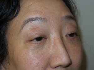 Blepharoplasty Before and After 03 | Sanjay Grover MD FACS