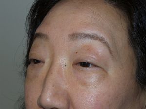 Blepharoplasty Before and After 03 | Sanjay Grover MD FACS