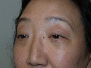 Blepharoplasty Before and After 03 | Grover Aesthetics