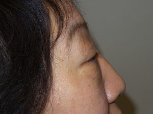 Blepharoplasty Before and After 03 | Grover Aesthetics