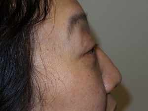 Blepharoplasty Before and After 03 | Grover Aesthetics