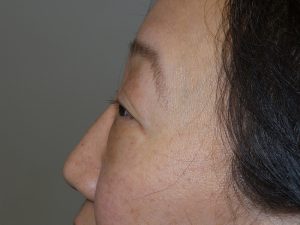 Blepharoplasty Before and After 03 | Grover Aesthetics