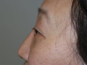 Blepharoplasty Before and After 03 | Grover Aesthetics