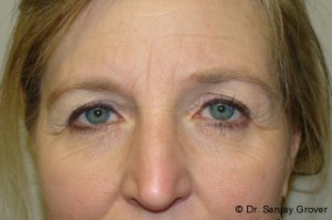 Blepharoplasty Before and After 27 | Sanjay Grover MD FACS