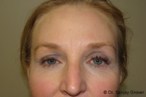 Blepharoplasty Before and After | Grover Aesthetics