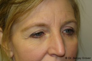 Blepharoplasty Before and After 04 | Sanjay Grover MD FACS