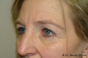 Blepharoplasty Before and After 04 | Sanjay Grover MD FACS