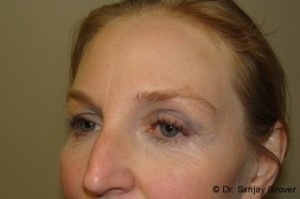 Blepharoplasty Before and After 04 | Sanjay Grover MD FACS