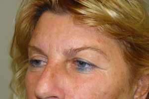 Blepharoplasty Before and After 05 | Sanjay Grover MD FACS