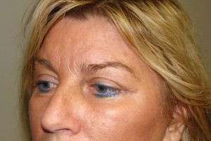 Blepharoplasty Before and After 05 | Sanjay Grover MD FACS