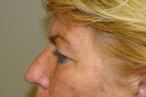 Blepharoplasty Before and After 05 | Sanjay Grover MD FACS