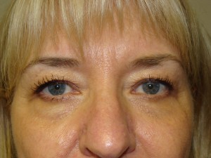 Blepharoplasty Before and After 11 | Sanjay Grover MD FACS