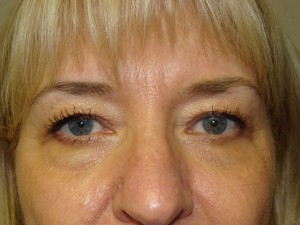 Blepharoplasty Before and After 16 | Sanjay Grover MD FACS