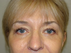 Blepharoplasty Before and After | Grover Aesthetics