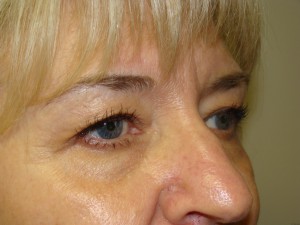 Blepharoplasty Before and After 06 | Sanjay Grover MD FACS