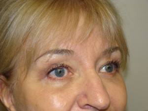 Blepharoplasty Before and After 06 | Sanjay Grover MD FACS