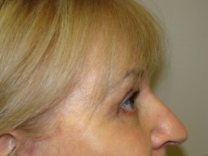 Blepharoplasty Before and After 06 | Grover Aesthetics