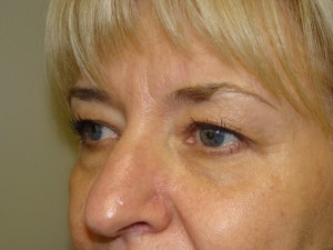 Blepharoplasty Before and After 06 | Sanjay Grover MD FACS