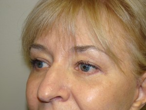 Blepharoplasty Before and After 06 | Sanjay Grover MD FACS