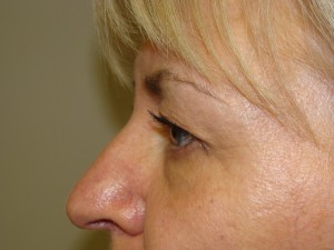 Blepharoplasty Before and After 06 | Sanjay Grover MD FACS