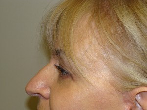 Blepharoplasty Before and After 06 | Sanjay Grover MD FACS