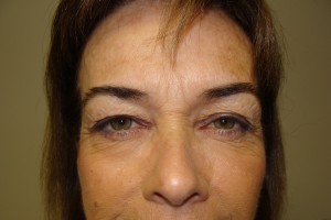 Blepharoplasty Before and After 02 | Sanjay Grover MD FACS