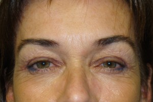 Blepharoplasty Before and After 07 | Sanjay Grover MD FACS