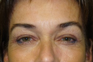 Blepharoplasty Before and After | Sanjay Grover MD FACS