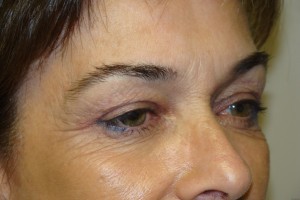 Blepharoplasty Before and After 07 | Sanjay Grover MD FACS