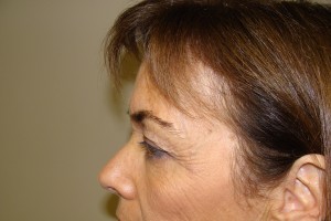 Blepharoplasty Before and After 07 | Sanjay Grover MD FACS